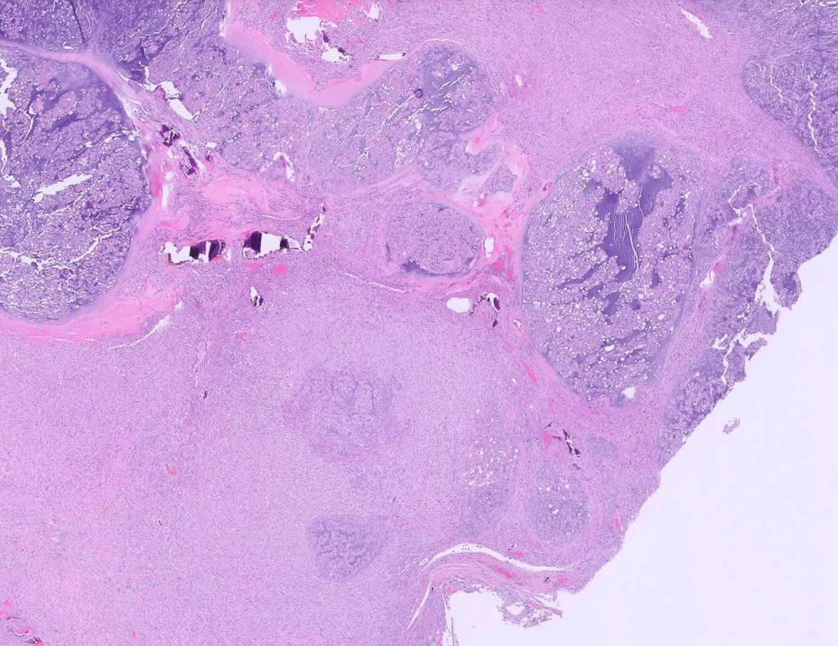 neuropathology's tweet image. Dedifferentiated chordoma, metastatic to the lung.  Without clinical hx, these can be very difficult to recognize, as Brachyury often negative (as it is here). #pathtwitter #pathx #cnspath #neuropath #neuropathology
