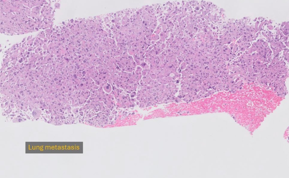 neuropathology's tweet image. Dedifferentiated chordoma, metastatic to the lung.  Without clinical hx, these can be very difficult to recognize, as Brachyury often negative (as it is here). #pathtwitter #pathx #cnspath #neuropath #neuropathology