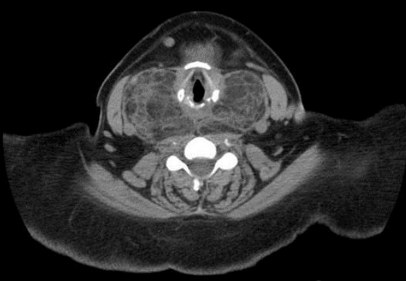 Shingo_Omata's tweet photo. <What's your diagnosis?>

Pt: 42 y/o Female

CC: Progressive neck mass x 6 yrs, recent compressive symptoms 

PMH: T2DM
PE: Neck: Lobulated, asymmetric diffuse thyroid enlargement
No lymphadenopathy
Labs: TFTs, CBC, BMP: WNL

#Rdiag #RadEd #MedEd https://t.co/0bSEEW0iFY