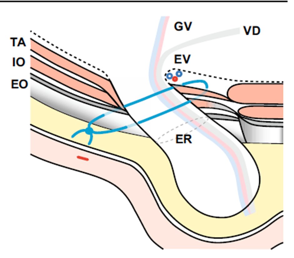 JoseJesusfb's tweet photo. PICS: semicierre percutáneo del canal inguinal, nueva técnica útil para hernias indirectas grandes (L3). Ventajas: disminución en la recurrencia y 0% de dolor crónico.
DOI: 10.1007/s00464-025-11569-9
#cirugia #hernias #medicina https://t.co/oQyrrJBsiC