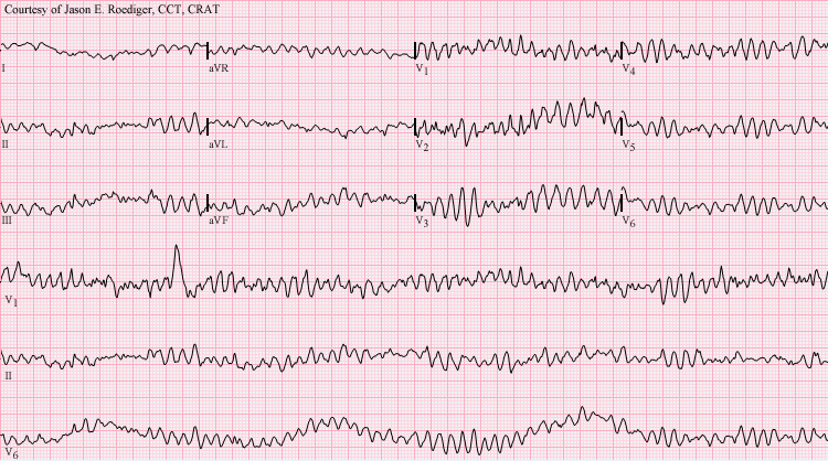 aderynsparklee's tweet photo. Selamat pagi abang/kakak, semangat menjalani hari Senin yang indah 🫶
Ngetes, ada yg tau ga ini pola ECG apaa? https://t.co/62FoAAkSRj