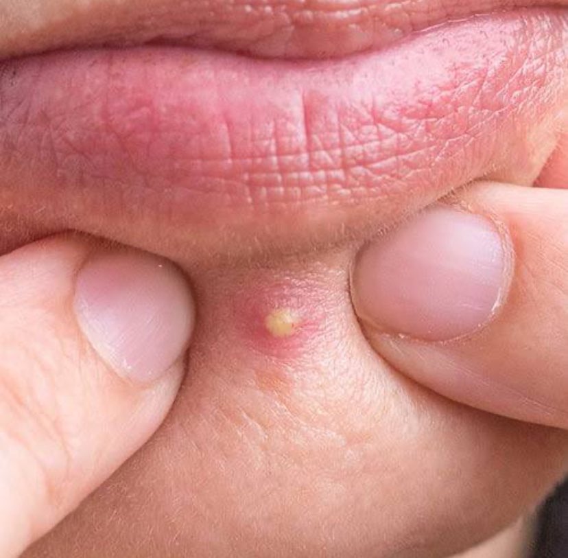 PharmGoody's tweet image. EVERYTHING YOU NEED TO KNOW ABOUT ACNE (PIMPLES): Causes, Treatment &amp;amp; Prevention!

Acne (pimples) is normal, but you don’t have to suffer through it? I know right it is frustrating but here is a thread to help you understand steps to a clearer skin!