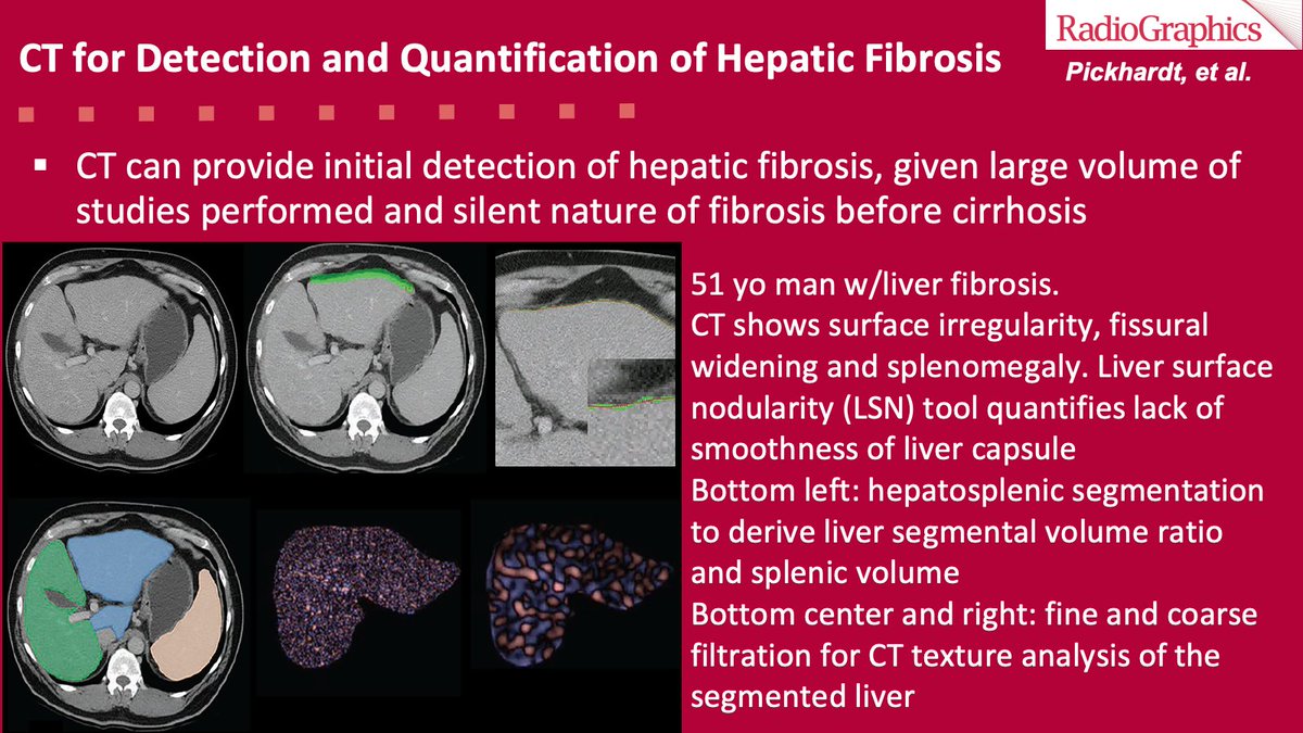 sbastawrous1's tweet photo. Liver fibrosis and cirrhosis are incidentally detected at CT and radiologists must be vigilant for relevant imaging features. The ability of quantitative CT in staging hepatic fibrosis can surpass US elastography
#RGphx #GIRad
@cookyscan1
@RadioGraphics https://t.co/B7KCIQT2d6