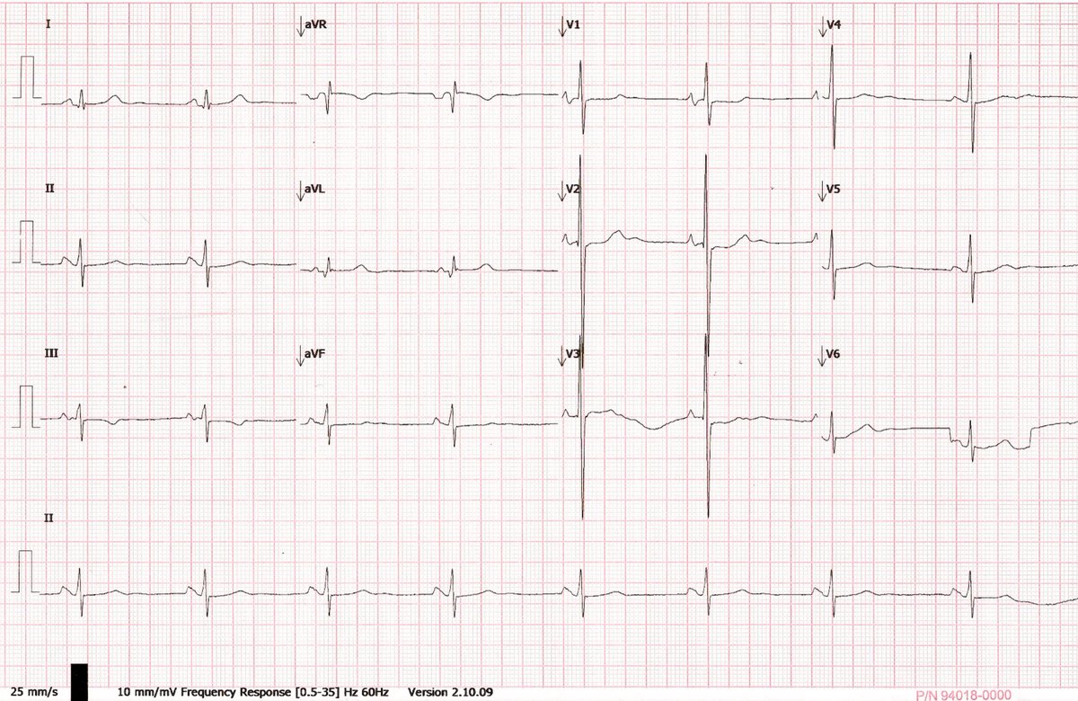 Joscarod's tweet photo. 63 Yo With worsening SOB in the ER. Chest X-Ray showed bilat pleural eff, pulmonary edema, left atrial enlargement (4 arch left contour, wide carina), prominent PA branches and EKG with RV strain (Tall R Waves V2) and LAA (Biphasic P wave V1) #ACC #FIT #ESC #EKG #CardioTwitter https://t.co/PFsyBYBDlI
