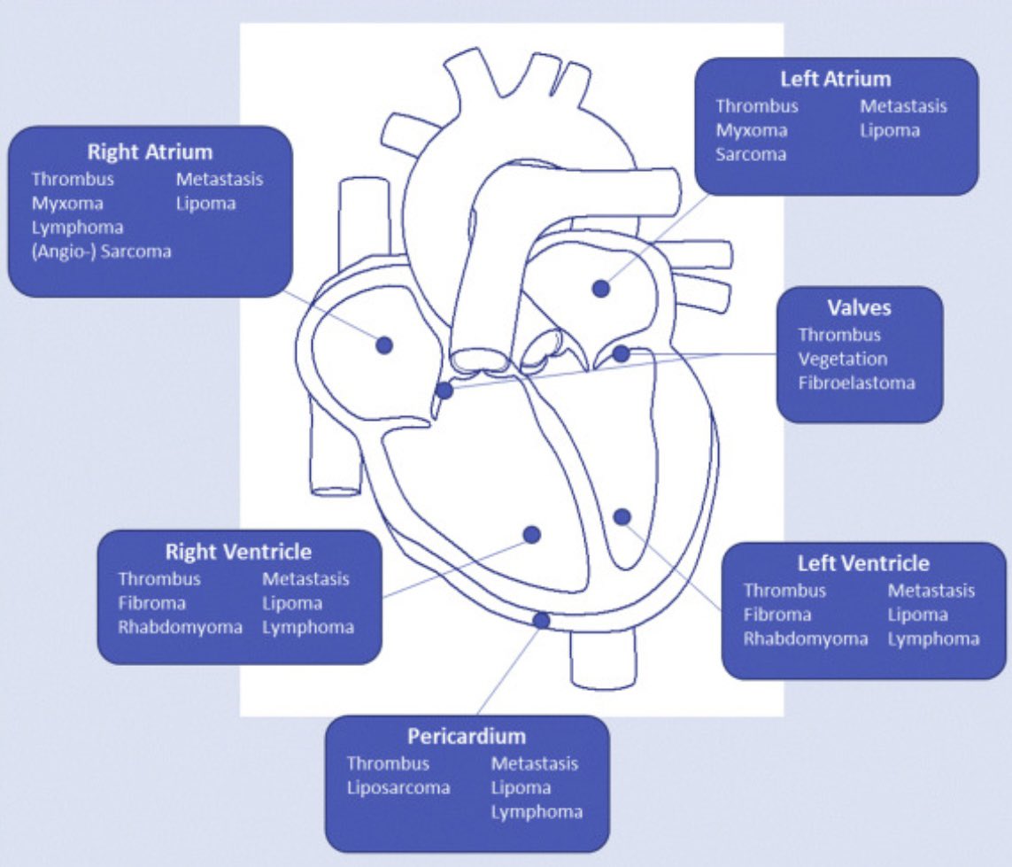 Joscarod's tweet photo. Here’s a brief map of possible etiologies according to chamber location and an algorithm on diagnostic approach #ACC #FIT #ESC #CardioTwitter https://t.co/i1NwvjRTvW