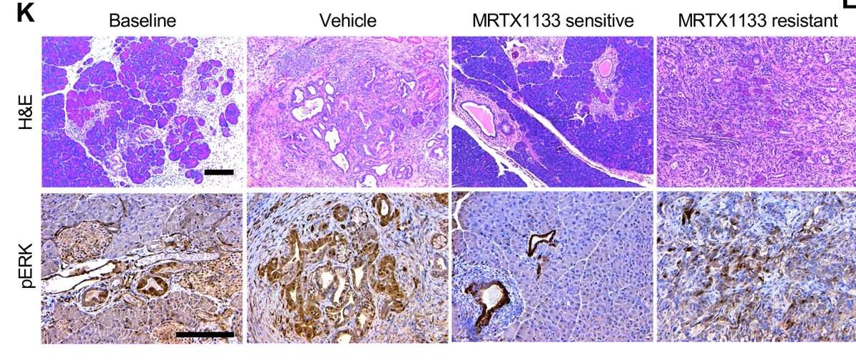 Anirban Maitra (@aiims1742) on Twitter photo New preprint by <a href="/mcandrews_kate/">Kate McAndrews</a> (previously <a href="/KalluriLab/">Kalluri Lab</a>, now PI at <a href="/MDAndersonNews/">MD Anderson Cancer Center</a>):
CDK8 remodels the tumor microenvironment to resist the therapeutic efficacy of targeted KRASG12D inhibition in #PancreaticCancer
In this preclinical study, Kate demonstrates that while acute New preprint by <a href="/mcandrews_kate/">Kate McAndrews</a> (previously <a href="/KalluriLab/">Kalluri Lab</a>, now PI at <a href="/MDAndersonNews/">MD Anderson Cancer Center</a>):
CDK8 remodels the tumor microenvironment to resist the therapeutic efficacy of targeted KRASG12D inhibition in #PancreaticCancer
In this preclinical study, Kate demonstrates that while acute