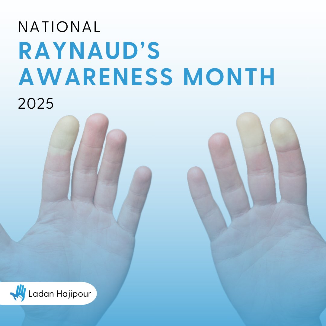 February is Raynaud's Awareness Month.🖐️

Did you know that around 1 in 6 people in the UK live with Raynaud's? This chronic condition can be triggered by cold temperatures or stress, causing blood vessels to constrict and temporarily stop blood flow.❄️

#RaynaudsAwareness