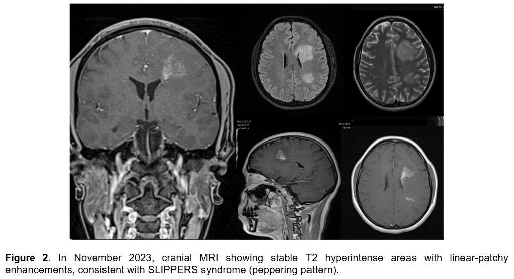MSJ (@msj_research) on Twitter photo Diagnostic challenges in SLIPPERS (Supratentorial Lymphocytic Inflammation with Parenchymal Perivascular Enhancement Responsive to Steroids) and related treatment implications.
Case report from <a href="/dribrahimacir/">ibrahim acır</a> <a href="/AYSEALT51949427/">AYSE ALTINTAS</a> ▶️ journals.sagepub.com/doi/full/10.11… Diagnostic challenges in SLIPPERS (Supratentorial Lymphocytic Inflammation with Parenchymal Perivascular Enhancement Responsive to Steroids) and related treatment implications.
Case report from <a href="/dribrahimacir/">ibrahim acır</a> <a href="/AYSEALT51949427/">AYSE ALTINTAS</a> ▶️ journals.sagepub.com/doi/full/10.11…