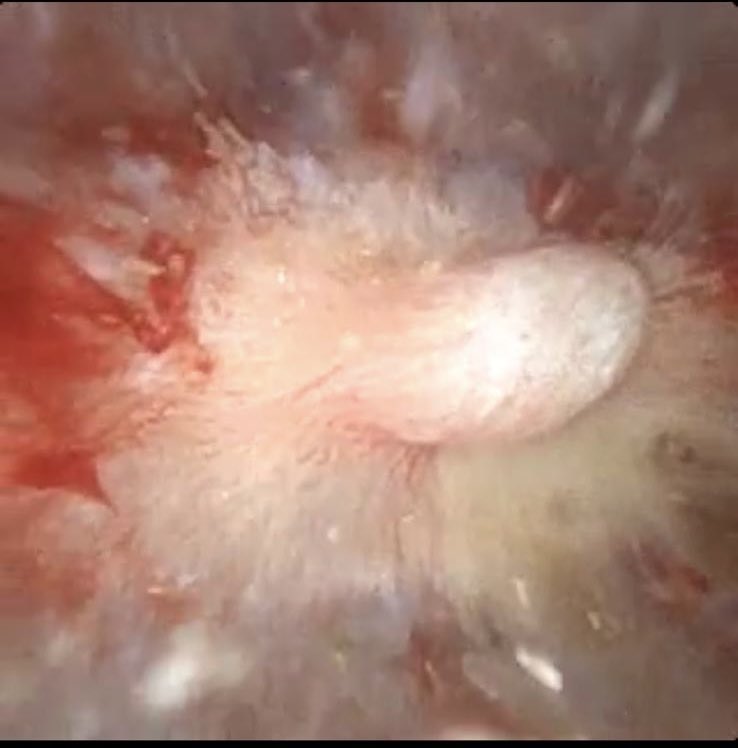 Leye Ajayi (@leye_ajayi) on Twitter photo Whilst manufacturers are miniaturising single use flexible ureterorenoscopy, <a href="/PusenMedical/">Pusen Medical</a> pivoted & developed a larger 9.2Fr with Direct In Suction SCOPE (DISS). The larger 5.1Fr working Channel facilities suction of residual stone fragments, ⬆️ SFR, ⬇️IRP & ⬇️IRT <a href="/cjmedicaluk/">CJ Medical</a> Whilst manufacturers are miniaturising single use flexible ureterorenoscopy, <a href="/PusenMedical/">Pusen Medical</a> pivoted & developed a larger 9.2Fr with Direct In Suction SCOPE (DISS). The larger 5.1Fr working Channel facilities suction of residual stone fragments, ⬆️ SFR, ⬇️IRP & ⬇️IRT <a href="/cjmedicaluk/">CJ Medical</a>