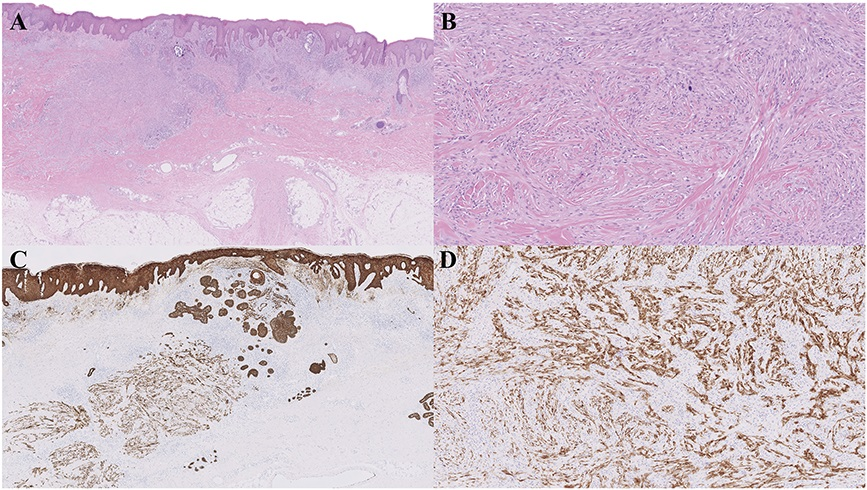 AJDP_Journal's tweet photo. #WhatsNewInDermpath
A case series of 16 cases of Primary Cutaneous Sarcomatoid Squamous Cell Carcinoma (PCSSCC) with aberrant smooth muscle actin expression: A clinicopathologic and immunophenotypic study
Fig 1D: SMA
Fig 2C: CKAE1/AE3, D: SMA https://t.co/lQIeSfyN6u