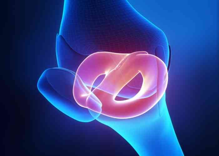 drprovencher's tweet photo. Wondering if you have #MeniscusDeficiency? If you're experiencing #kneepain, a thorough exam by is key. With an #MRI and x-rays, he'll determine the extent of any #meniscustear & cartilage loss. Take care of your knees—your active lifestyle depends on it! https://t.co/s8FG7STMYf https://t.co/ziEZabd4cP