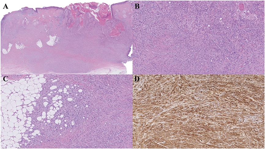 AJDP_Journal's tweet photo. #WhatsNewInDermpath
A case series of 16 cases of Primary Cutaneous Sarcomatoid Squamous Cell Carcinoma (PCSSCC) with aberrant smooth muscle actin expression: A clinicopathologic and immunophenotypic study
Fig 1D: SMA
Fig 2C: CKAE1/AE3, D: SMA https://t.co/lQIeSfyN6u