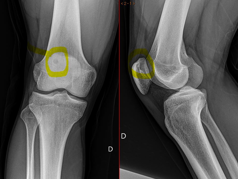 JuanMiranda (@themskarchive) on Twitter photo 3/2/2025. 🟩DIAGNOSIS: Dorsal patella defect.
Superolateral external patellar facet OC defect
<a href="/Kdog1980YNWA/">Kdog1980</a> <a href="/alerian007/">Ahmed Atyya</a> <a href="/AmineKorchiMD/">Dr Amine Korchi</a>
<a href="/Dr_OscarMadruga/">Oscar Madruga Armada</a> <a href="/paudelsuman44/">Suman Paudel</a> <a href="/Babs45Babs/">Babs</a> <a href="/mhudack001/">Michael Hudack</a>
Two more examples:
1⃣x.com/themskarchive/…
2⃣x.com/themskarchive/… 3/2/2025. 🟩DIAGNOSIS: Dorsal patella defect.
Superolateral external patellar facet OC defect
<a href="/Kdog1980YNWA/">Kdog1980</a> <a href="/alerian007/">Ahmed Atyya</a> <a href="/AmineKorchiMD/">Dr Amine Korchi</a>
<a href="/Dr_OscarMadruga/">Oscar Madruga Armada</a> <a href="/paudelsuman44/">Suman Paudel</a> <a href="/Babs45Babs/">Babs</a> <a href="/mhudack001/">Michael Hudack</a>
Two more examples:
1⃣x.com/themskarchive/…
2⃣x.com/themskarchive/…