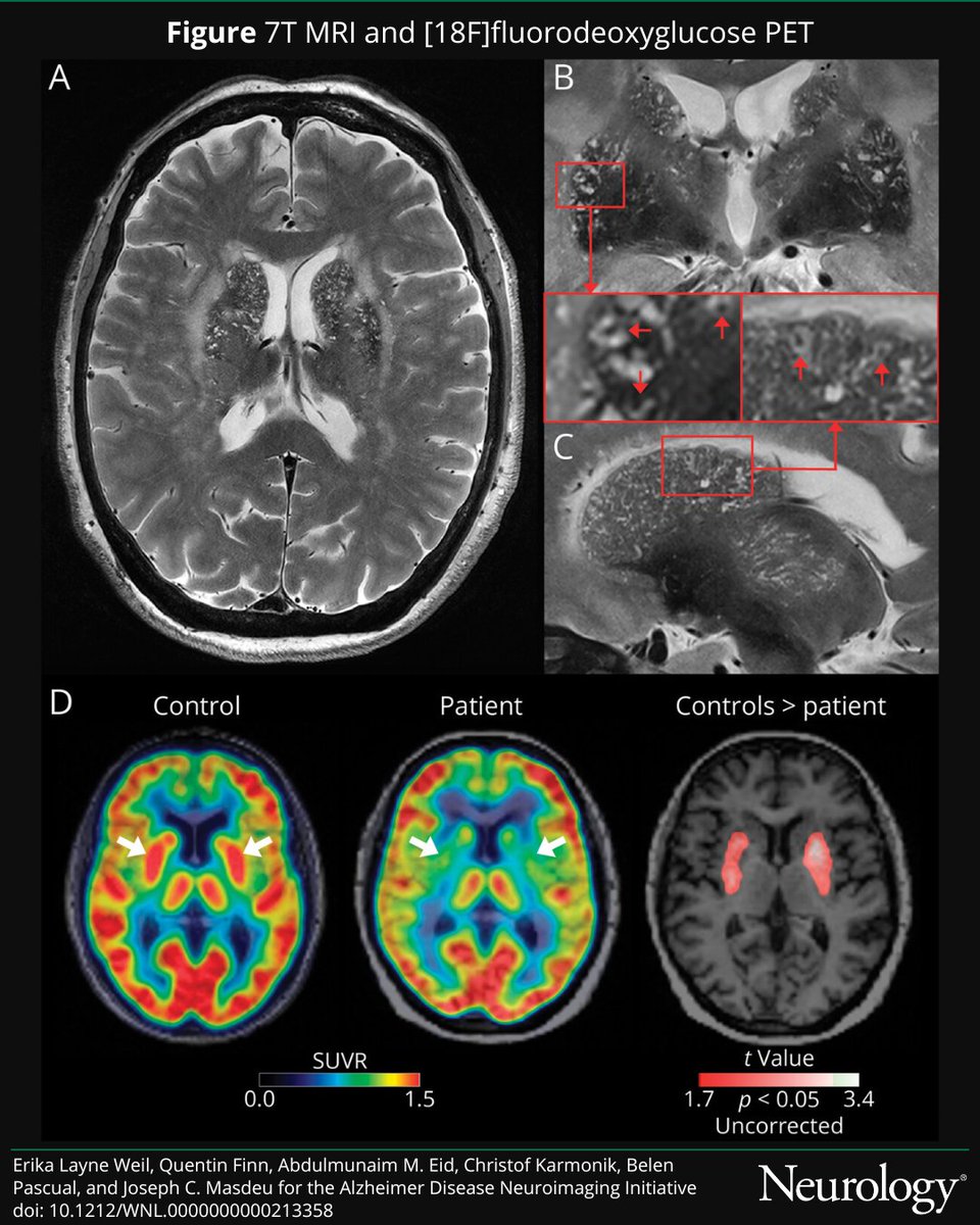 NeuroImage: État Criblé—High-Resolution MRI and Metabolism 
hubs.la/Q034TwgQ0

#NeuroTwitter #NeuroX