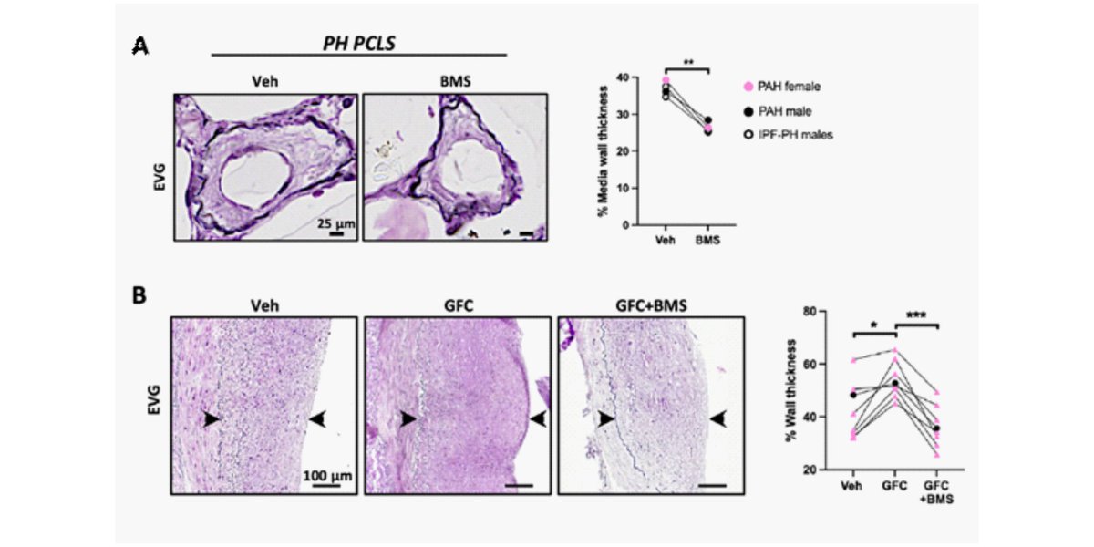 CPI (@cpi_exstra) on Twitter photo 🌟New research from the groups of <a href="/sbonnet2/">Sebastien « Seb » Bonnet</a> and <a href="/PullamsettiL/">Pullamsetti Lab</a> highlights ATP citrate lyase as a potential therapeutic target for vascular diseases. This study is one of the first to address the common mechanisms of systemic and pulmonary vascular diseases. cpi-online.de/paperofthemont… 🌟New research from the groups of <a href="/sbonnet2/">Sebastien « Seb » Bonnet</a> and <a href="/PullamsettiL/">Pullamsetti Lab</a> highlights ATP citrate lyase as a potential therapeutic target for vascular diseases. This study is one of the first to address the common mechanisms of systemic and pulmonary vascular diseases. cpi-online.de/paperofthemont…