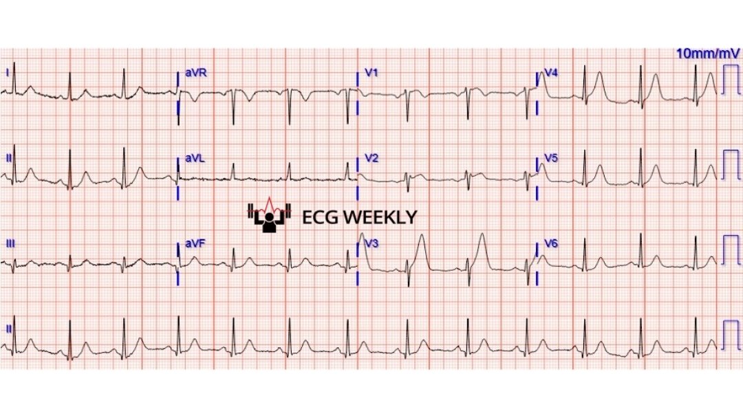 A 54-year-old man presents to the emergency department with chest pain concerning for an acute coronary syndrome. An initial ECG is performed on arrival and appears normal, the following repeat ECG is obtained 30 minutes later for ongoing pain ... rebrand.ly/zmcrxvf