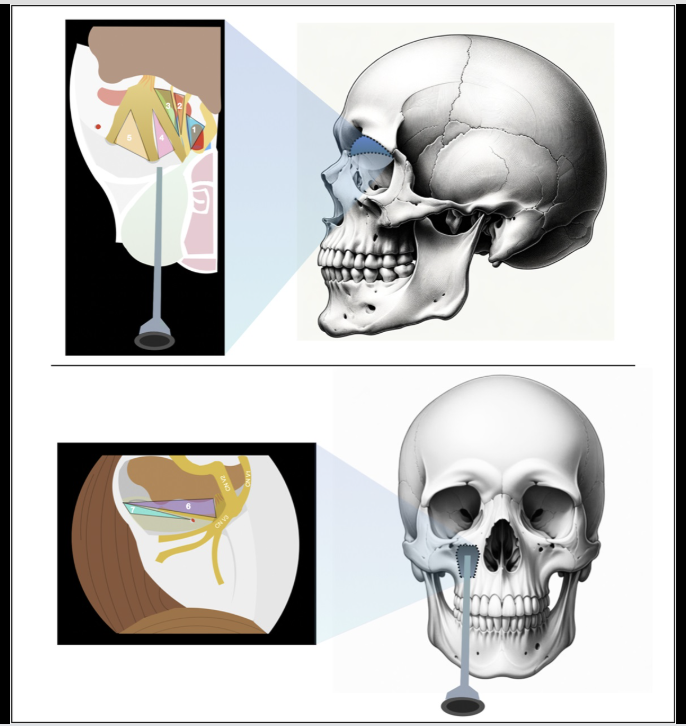 Neurosurgery Publications (@neurosurgerycns) on Twitter photo #ONSNew Biportal Endoscopic TransOrbital and transMaxillary Approach to the Cranio-Orbital Region and Middle Cranial Fossa: A Preliminary Analysis of Maneuverability bit.ly/4aIb2CY by <a href="/Leonard_T_MD/">Leonardo Tariciotti, M.D.</a> et al <a href="/EmoryMedicine/">Emory School of Medicine</a> <a href="/MdOlabisi/">Olabisi Sanusi MD, FAANS</a> <a href="/CNS_Update/">CNS</a> #ONSNew Biportal Endoscopic TransOrbital and transMaxillary Approach to the Cranio-Orbital Region and Middle Cranial Fossa: A Preliminary Analysis of Maneuverability bit.ly/4aIb2CY by <a href="/Leonard_T_MD/">Leonardo Tariciotti, M.D.</a> et al <a href="/EmoryMedicine/">Emory School of Medicine</a> <a href="/MdOlabisi/">Olabisi Sanusi MD, FAANS</a> <a href="/CNS_Update/">CNS</a>