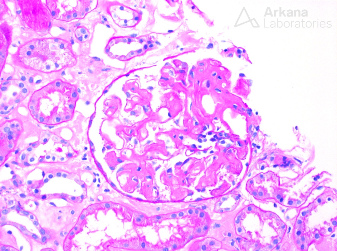 arkanalabs's tweet image. What is your diagnosis?

#DiagnoseThis #renalpath #nephropath