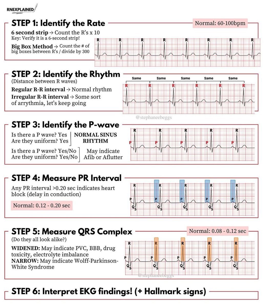 Here is the link for free ECG training resources: 
youtube.com/playlist?list=…