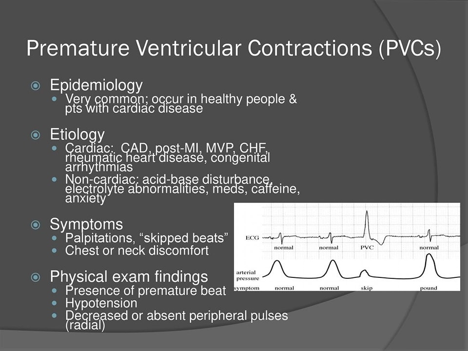 ZHeart11768530's tweet photo. 🔴Premature Ventricular Contraction (PVC):⤵️
  🔹Epidemiology
  🔹ECG Characterstics    
  🔹Prognosis and Treatment
🩸🩸🩸
#MedEd #PhysioMed #MedX #Diagnosis
 #Cardiology #FOAMed #MedEd #medstudent #paramedic #Cardiology #CardioEd #medtwitter #meded https://t.co/fXhfGFI5a7