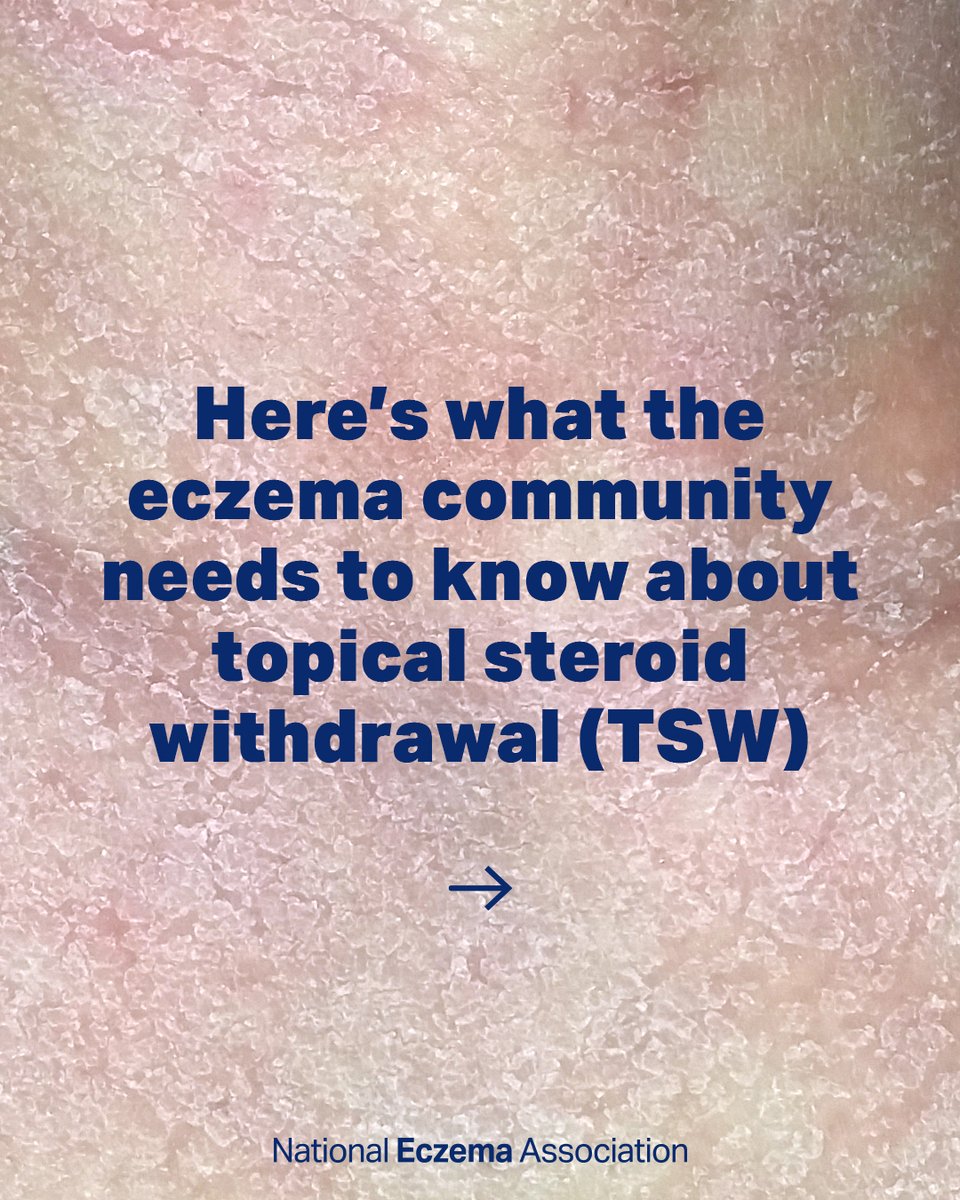nationaleczema's tweet photo. Read our article about what the eczema community needs to know about topical steroid withdrawal (TSW): https://t.co/dFt9jmXMtx
💙 
Visit @ITSANnonprofit  for more information and support.

#SkinHealth #EczemaWarrior #EczemaWarriors #TSWCommunity #TSWAwareness  #TSWWarrior https://t.co/DWnnWArger