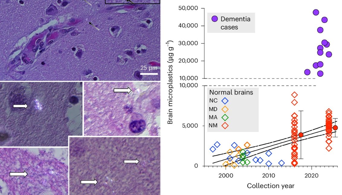 The human brain contains an entire spoon’s worth of microplastics - levels were even higher in those with dementia.

🧵1/10