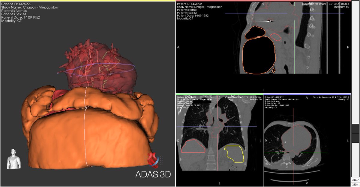 Cristiano Pisani (@crpisani) on Twitter photo Chagas Megacolon in VT. Colon relationship identified using <a href="/ADAS3D/">ADAS3D Medical</a> software. First was a case scheduled for today and we decided not to go epi, second an old case that had an Huge megacolon that went to surgery <a href="/Dr_Santangeli/">Pasquale Santangeli</a> <a href="/DrRoderickTung/">Roderick Tung</a> <a href="/LuigiDiBiaseMD/">Luigi Di Biase</a> <a href="/aalahmadmd/">Amin Al-Ahmad, MD</a> Chagas Megacolon in VT. Colon relationship identified using <a href="/ADAS3D/">ADAS3D Medical</a> software. First was a case scheduled for today and we decided not to go epi, second an old case that had an Huge megacolon that went to surgery <a href="/Dr_Santangeli/">Pasquale Santangeli</a> <a href="/DrRoderickTung/">Roderick Tung</a> <a href="/LuigiDiBiaseMD/">Luigi Di Biase</a> <a href="/aalahmadmd/">Amin Al-Ahmad, MD</a>
