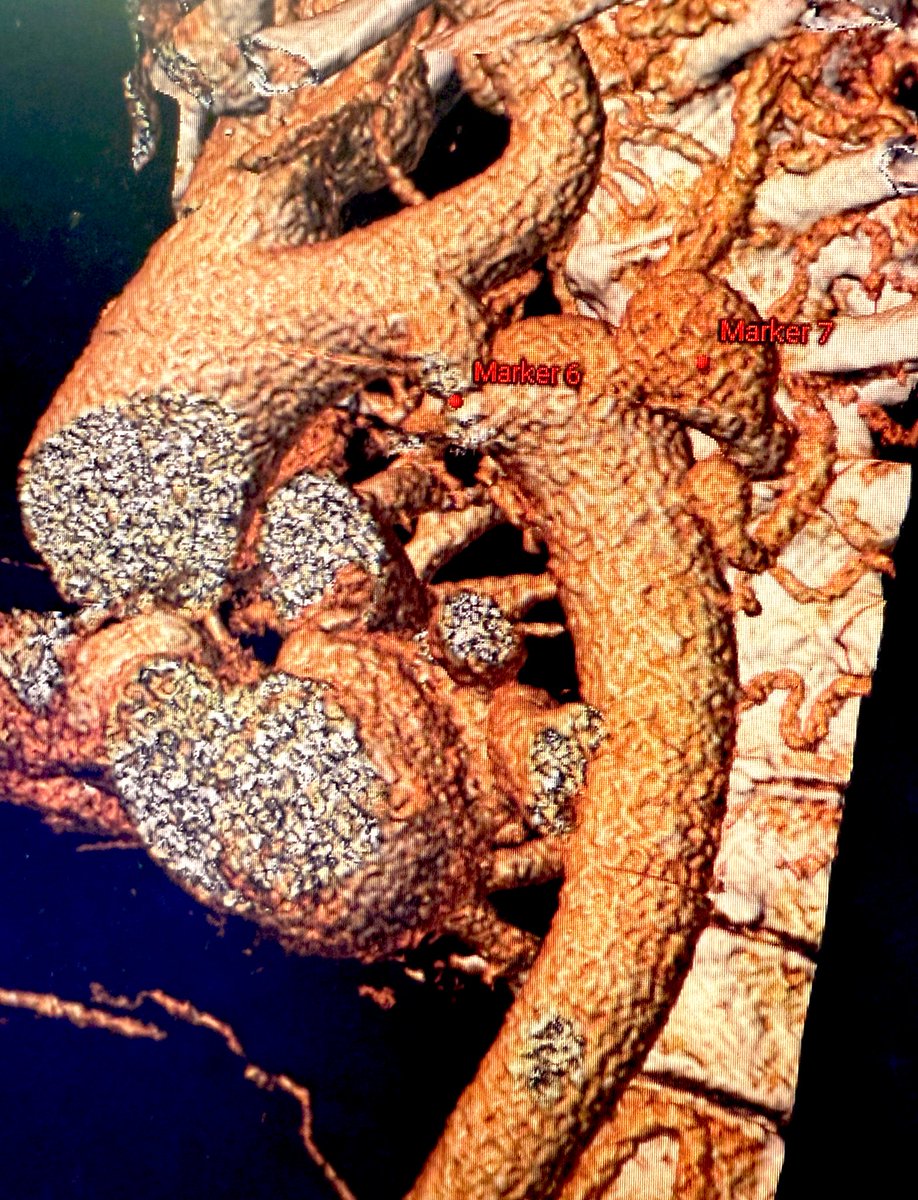 Ignacio J. Amat (@ignamatsant) on Twitter photo How would you treat this case?
Male in his 50s + Very severe coarctation + distal aneurysm receiving 2 big colaterals:
👉see the poll 🧵
<a href="/PCRonline/">PCRonline 🫀</a> <a href="/solaci_online/">SOLACI</a> <a href="/Ped_cardio/">Cardiopedia</a> <a href="/secardiologia/">Soc Esp Cardiología</a> <a href="/CSIcongress/">CSI Congress</a> <a href="/TCTMD/">TCTMD</a> How would you treat this case?
Male in his 50s + Very severe coarctation + distal aneurysm receiving 2 big colaterals:
👉see the poll 🧵
<a href="/PCRonline/">PCRonline 🫀</a> <a href="/solaci_online/">SOLACI</a> <a href="/Ped_cardio/">Cardiopedia</a> <a href="/secardiologia/">Soc Esp Cardiología</a> <a href="/CSIcongress/">CSI Congress</a> <a href="/TCTMD/">TCTMD</a>