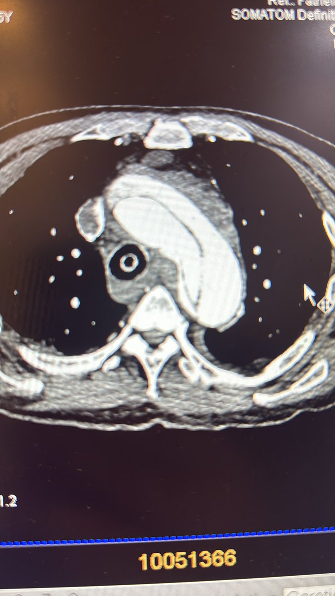 Qx3zo's tweet photo. .
اذا طلبوا منك Code Stroke لاشتباه جلطة وشفت هالمنظر 
.
نصيحة أخ انزل لين الـ Pelvic Aorta لتحديد الـ Aortic dissection
.
لان المريض ٩٩٪ بحاجة الى جراحة لمعالجة انسلاخ الـ Aorta لان مثل ماهو واضح الـAorta منقسم الى نصفين واحتمال انو قاعد ينزف وهالسبب يكون من ارتفاع الضغط https://t.co/lsz1IC9Odc