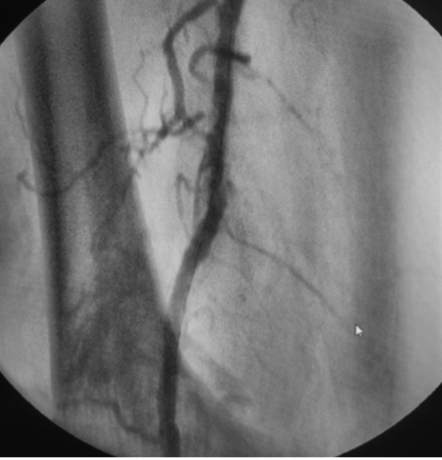 RaciRevista's tweet photo. Tratamiento adicional a la recanalización de oclusión crónica de arteria femoral superficial, con sistema de #aterectomía rotacional periférica
Additional treatment to recanalization of chronic superficial femoral artery occlusion using peripheral rotational #atherectomy system. https://t.co/8BGAAf8zeL
