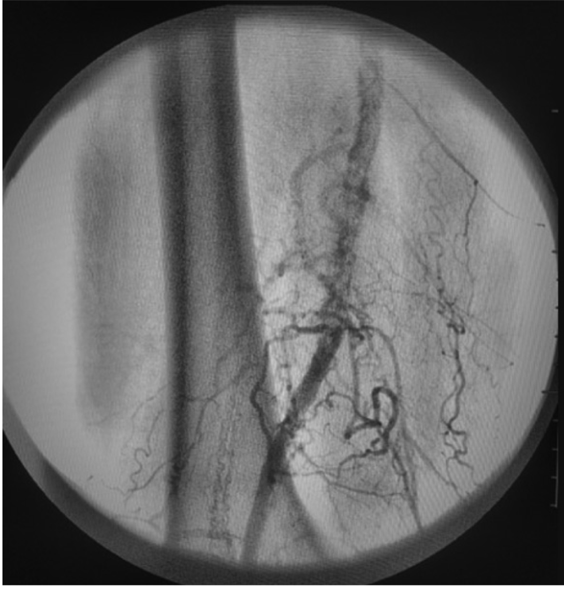 RaciRevista's tweet photo. Tratamiento adicional a la recanalización de oclusión crónica de arteria femoral superficial, con sistema de #aterectomía rotacional periférica
Additional treatment to recanalization of chronic superficial femoral artery occlusion using peripheral rotational #atherectomy system. https://t.co/8BGAAf8zeL
