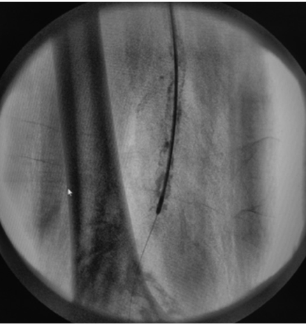RaciRevista's tweet photo. Tratamiento adicional a la recanalización de oclusión crónica de arteria femoral superficial, con sistema de #aterectomía rotacional periférica
Additional treatment to recanalization of chronic superficial femoral artery occlusion using peripheral rotational #atherectomy system. https://t.co/8BGAAf8zeL