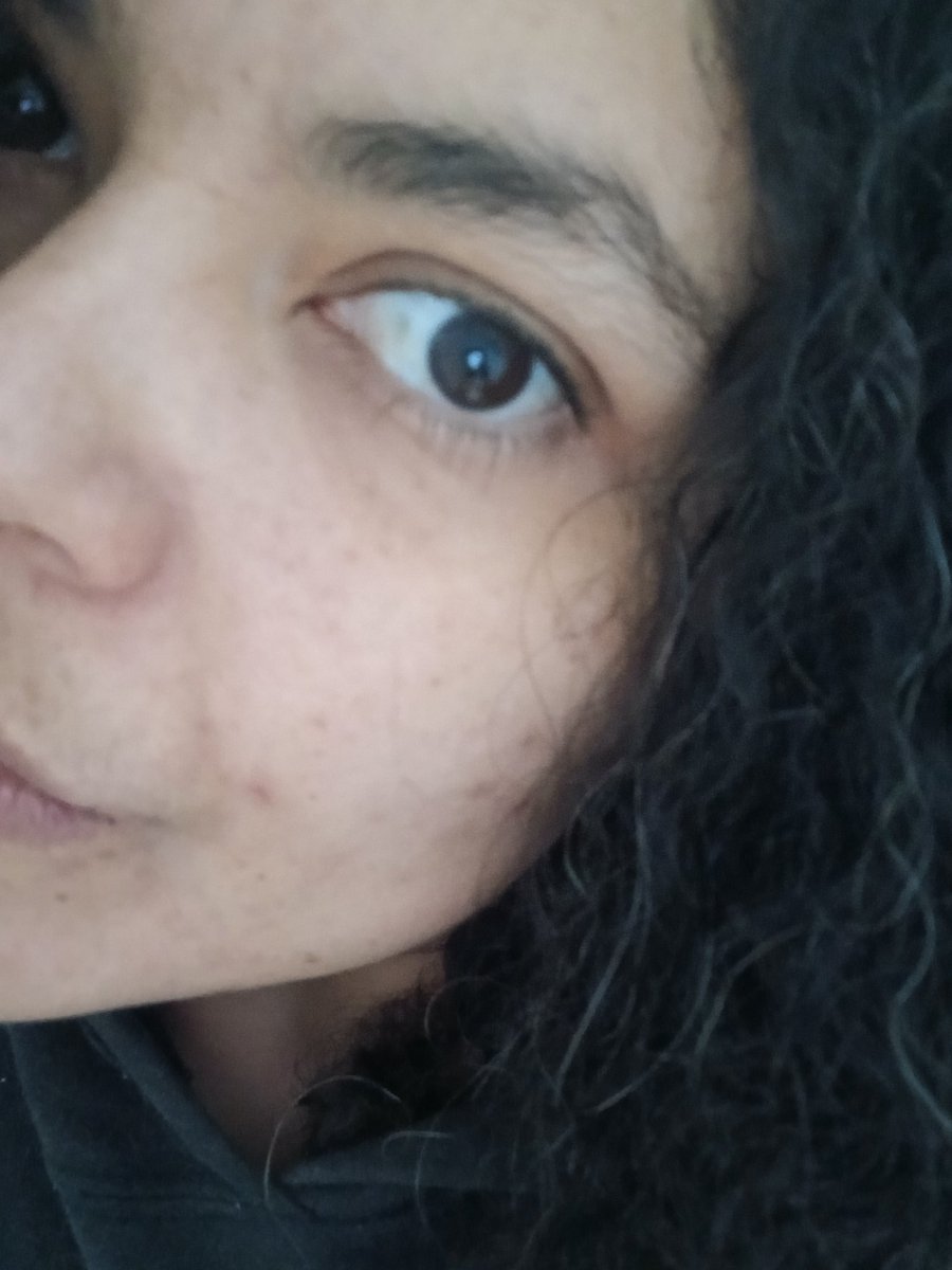 LeonardoIsaura's tweet photo. Casi un mes de tratamiento. #dermatitis #pielsensible #acné https://t.co/0eKl1Kw0nq