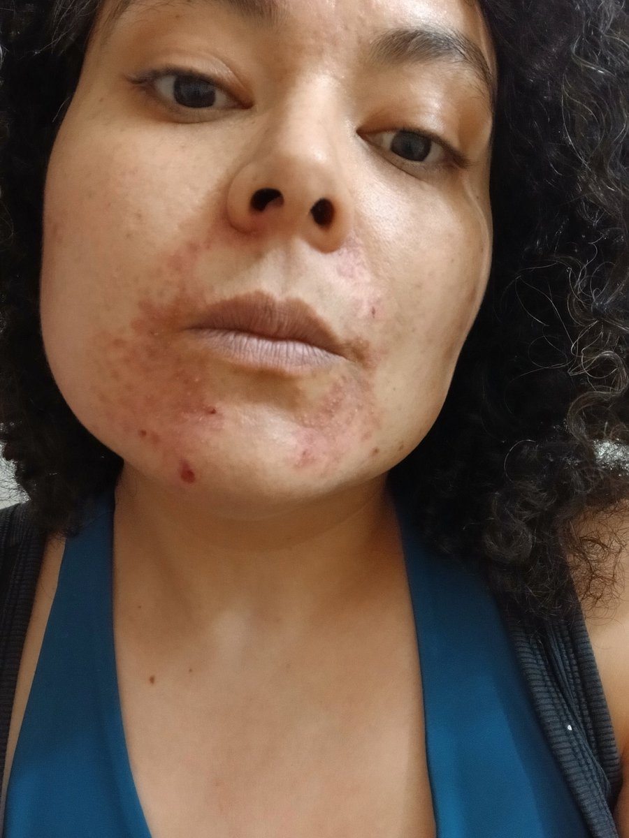 LeonardoIsaura's tweet photo. Casi un mes de tratamiento. #dermatitis #pielsensible #acné https://t.co/0eKl1Kw0nq