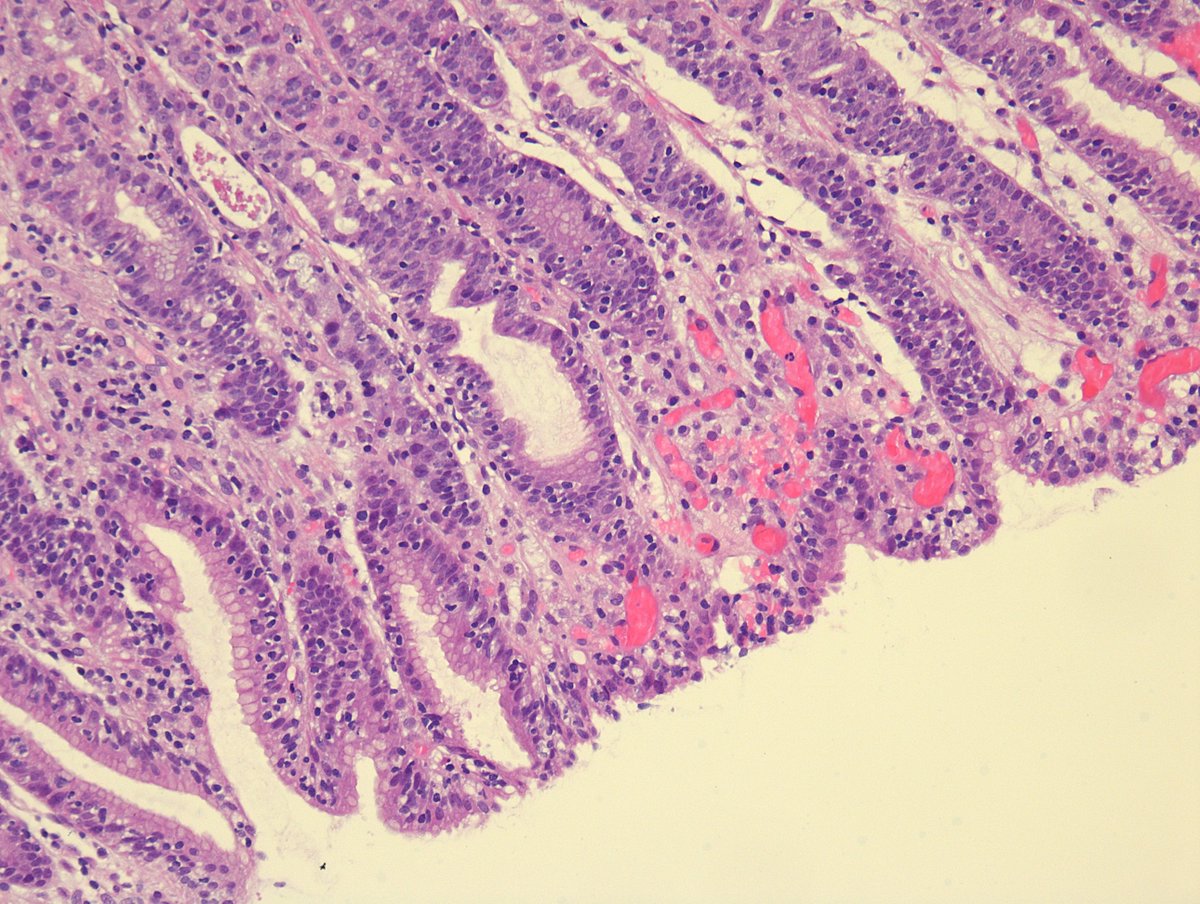 MirunaPopescu13's tweet image. 40s F, gastric erythema.

🔬What's your diagnostic impression? What are some common etiologies of this injury pattern and what would be your next step in the work-up of such a case?

#GIPath #PathTwitter #pathresidents #pathfellows