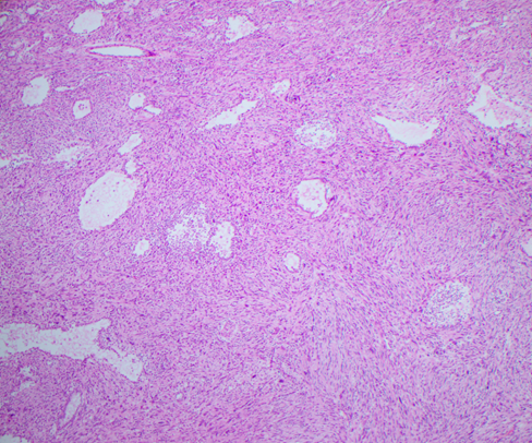 LatinAmericanPF's tweet photo. NF1 es un síndrome neuroocular-cutáneo en lo que los pacientes están predispuestos a sufrir tumores. A este paciente se le diagnosticó un tumor maligno de la vaina del nervio periférico de la axila. La metástasis pulmonar muestra diferenciación glandular.
Autor: @NMShillingford https://t.co/V44dXVURbJ
