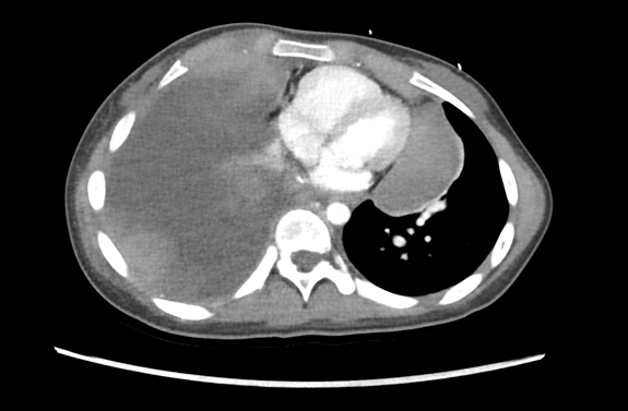 LatinAmericanPF's tweet photo. NF1 es un síndrome neuroocular-cutáneo en lo que los pacientes están predispuestos a sufrir tumores. A este paciente se le diagnosticó un tumor maligno de la vaina del nervio periférico de la axila. La metástasis pulmonar muestra diferenciación glandular.
Autor: @NMShillingford https://t.co/V44dXVURbJ