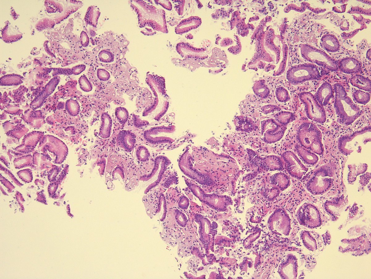 MirunaPopescu13's tweet photo. 50s M. Mosaic-like/snake skin pattern of gastric mucosa. You see this aspect in the gastric antrum. What's your next step? Diagnosis? ππ¬
#PathTwitter #GIPath #pathresidents #pathfellows https://t.co/j9AYOeAPQI