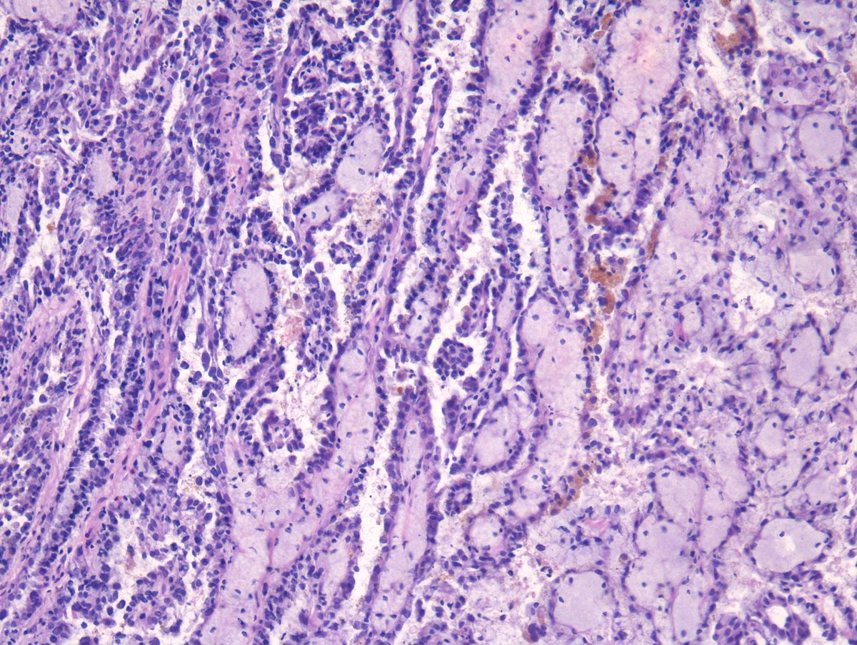 MirunaPopescu13's tweet photo. #GUPath frozen section of a renal mass.
What's your diagnosis? π¬
#PathTwitter #FrozenSection #pathresidents #pathfellows https://t.co/wGBWdi0grP