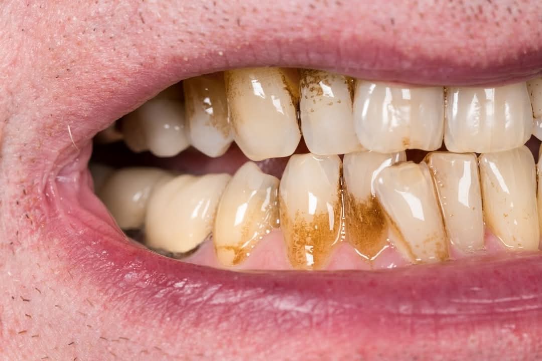 odontomap's tweet photo. ⚠️ ¡Cuidado! ⚠️

¡La placa dental puede afectar seriamente tu salud!

Las bacterias de la placa no solo dañan tus dientes, también pueden ingresar a tu torrente sanguíneo y aumentar el riesgo de enfermedades cardiovasculares, diabetes y otros problemas de salud.

#PlacaDental https://t.co/mSWACGfsCo