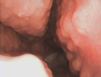 “Cobblestoning” of the nasal mucosa bilaterally in a patient with nasal sarcoidosis.  Take it from me:  never operate on these patients, as the whole nose can break down completely. The treatment is medical.
#ENTX