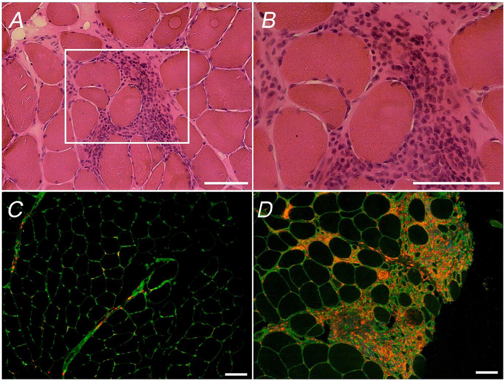 Muscle Cell News (@musclecellnews) on Twitter photo 💪 Scientists with Dr. Oscar Horwath at <a href="/orebrouni/">Örebro universitet</a> suggested that combined exercise training elicited beneficial muscular adaptations without impairing important indicators of skeletal #muscle regenerative capacity in patients with #FSHD.
👉 <a href="/JPhysiol/">Journal of Physiology</a> | bit.ly/4hIhwnH 💪 Scientists with Dr. Oscar Horwath at <a href="/orebrouni/">Örebro universitet</a> suggested that combined exercise training elicited beneficial muscular adaptations without impairing important indicators of skeletal #muscle regenerative capacity in patients with #FSHD.
👉 <a href="/JPhysiol/">Journal of Physiology</a> | bit.ly/4hIhwnH
