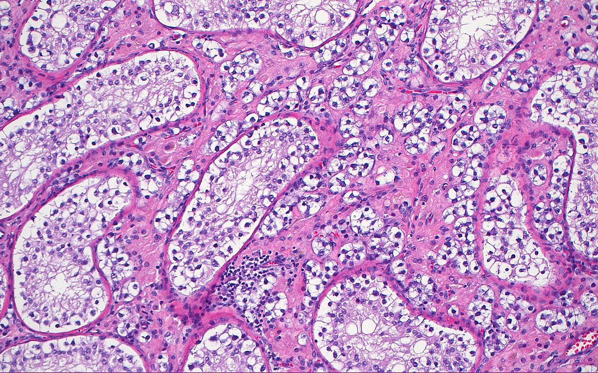 Ziad El-Zaatari (@ziad_zaatari) on Twitter photo 🔬 Interstitial Seminoma ~ #GUpath #Testis #Pathology #PathArt 🔬 Interstitial Seminoma ~ #GUpath #Testis #Pathology #PathArt