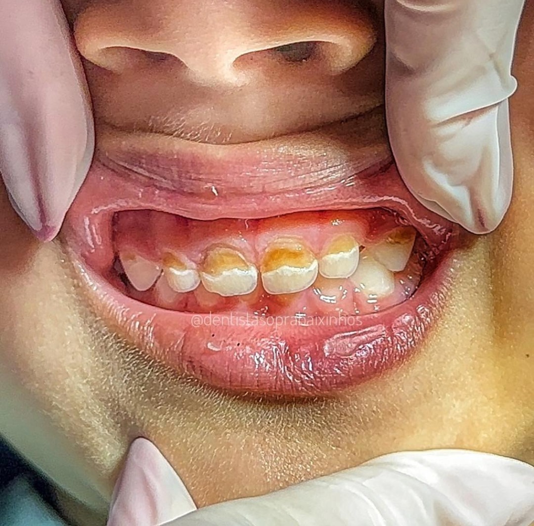DentMaya's tweet photo. ¡N😡😠🤬!
Esto NO es falta de calcio😡
No es un defecto de formación🤬
😱¡Estas son lesiones de caries activas!😭

Esto sucede debido al consumo de alimentos ricos en sacarosa y carbohidratos fermentables😢, seguido de un deficiente, mal o hasta nulo cepillado🪥 https://t.co/9A88Gi7Ipi