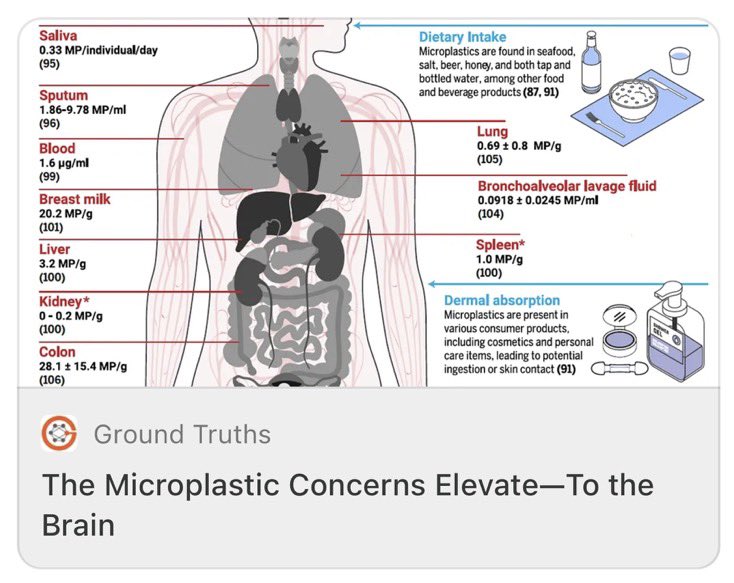 Supriya Sahu IAS (@supriyasahuias) on Twitter photo Microplastics have reached human brain !
A new study in <a href="/NatureMedicine/">Nature Medicine</a> finds alarming levels of microplastics accumulating in human brains. The findings link higher microplastic loads to dementia, raising urgent questions.
Where are these plastics coming from? Food, water, air, Microplastics have reached human brain !
A new study in <a href="/NatureMedicine/">Nature Medicine</a> finds alarming levels of microplastics accumulating in human brains. The findings link higher microplastic loads to dementia, raising urgent questions.
Where are these plastics coming from? Food, water, air,