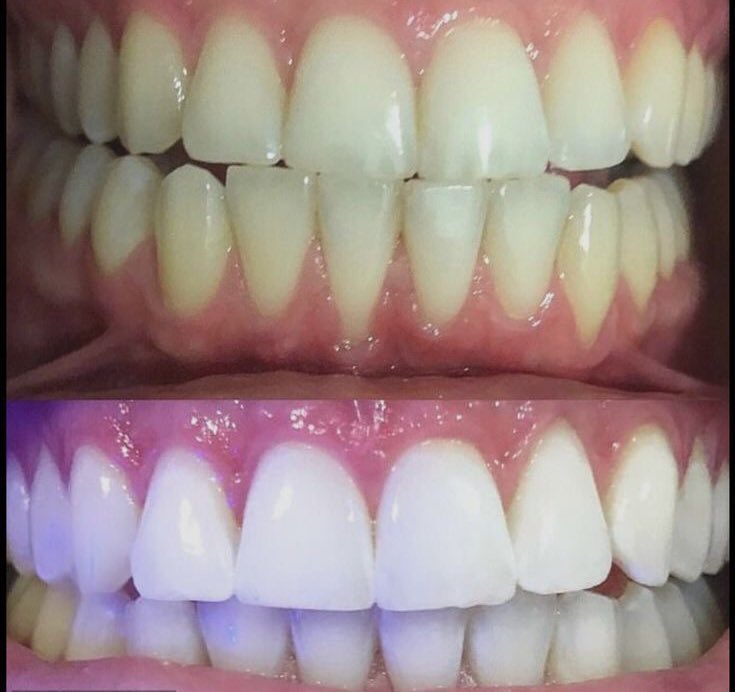 Iamsallieluv's tweet photo. Get a Healthy White Teeth and Fresh Breathe Naturally!

Get your activated charcoal ready and open this thread…👇🏽

🧵 https://t.co/qwkeWQTOL2