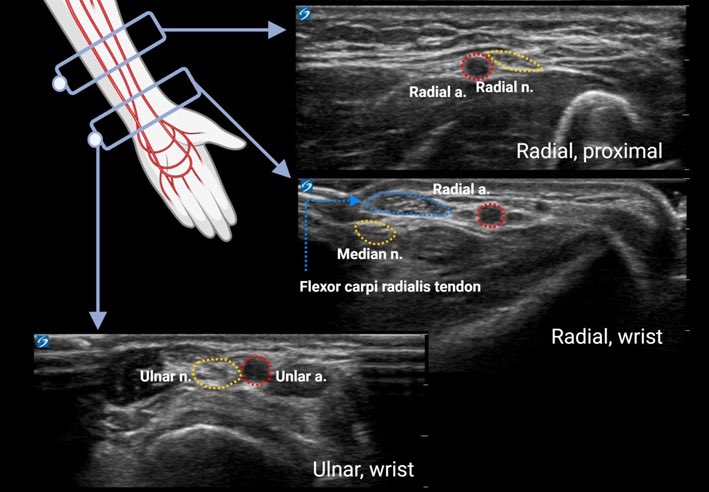 Why in 2025 are people still obsessed with RADIAL art lines?

The ULNAR artery is usual bigger &amp; farther from the nerve.

Yes, the RADIAL is more superficial &amp; easier to landmark but with POCUS it doesn’t matter!

Is the RADIAL preference just a holdover from the pre-POCUS times?