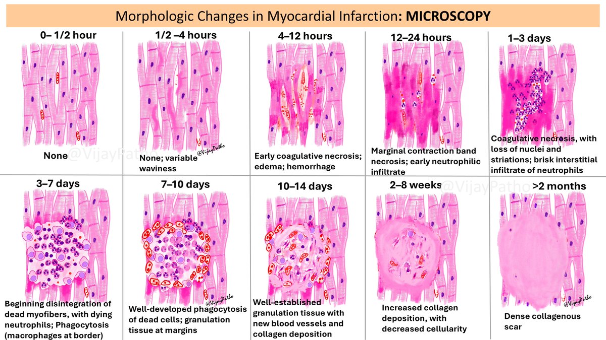 Morphologic Changes in Myocardial Infarction: A Microscopic Journey 

Illustrating histopathology is one of the best ways to teach and learn! If you're interested in drawing, try illustrating histological changes—it helps in retaining concepts better and makes learning fun.
This