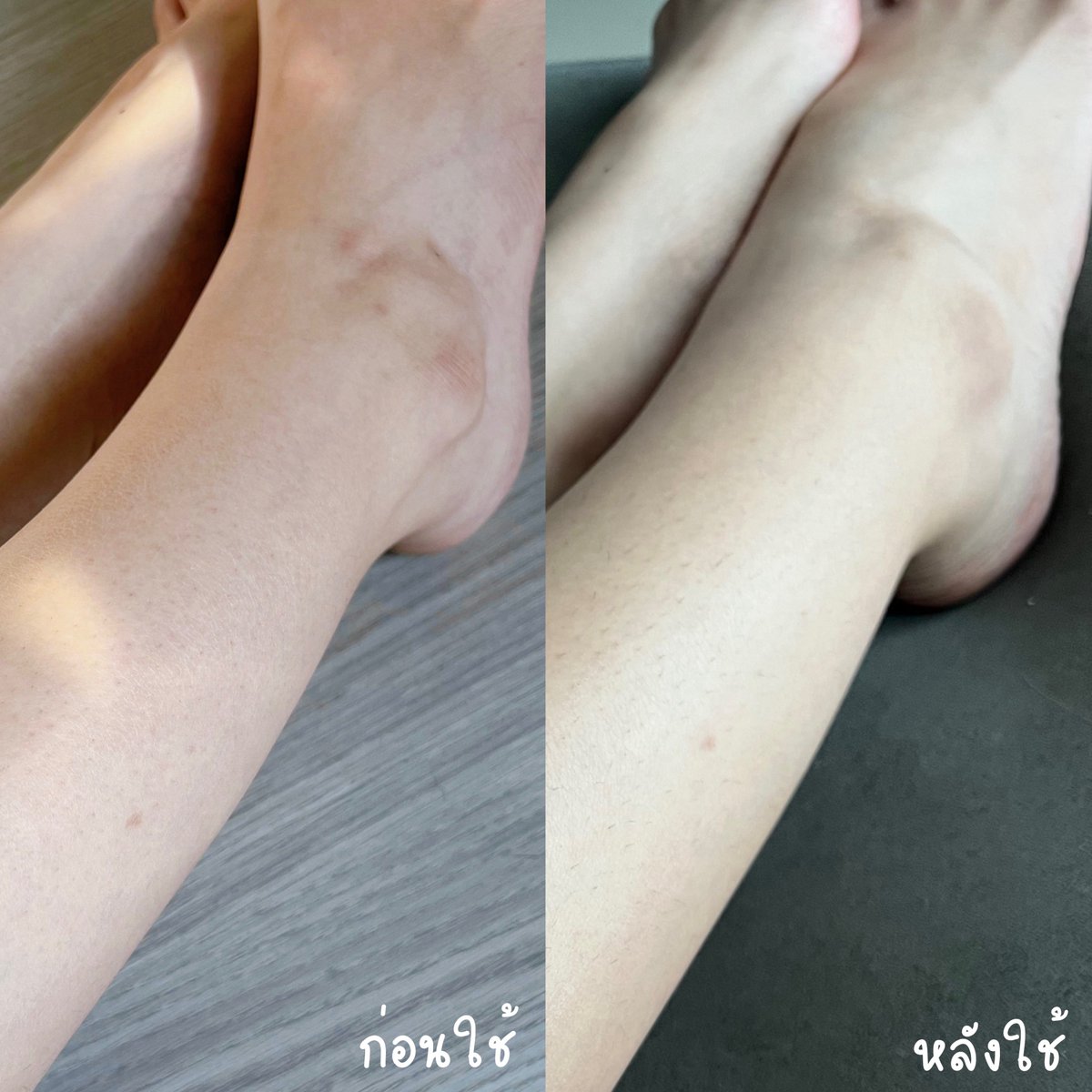 สองสัปดาห์รู้เรื่องงง! นี่โดนยุงกัด กับรองเท้ากัดอะ รอยดำทำขาไม่เนียนใช้ชีวิตแบบไม่มั่นใจผิวสุดๆ แต่ใช้วาสลีนหลอดม่วงอันนี้ แล้วเอ้อออ จุดดำจางลงเยอะมากก แอสต้าแซนธินชีเสิร์ฟ ขาเนียน ชุ่มชื้น มีกันแดดด้วย ไอเลิ้บมากกก #ตัวจบผิวลายจุด #กลูต้าแอสต้า
