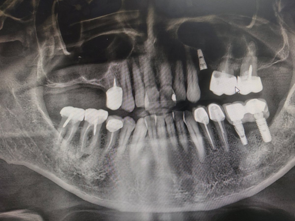 Kanal yapmadan post-kuron yapmışlar 15 yıldır hiçbir şikayet yok. Bizde kanalda yarım mm kısa kalınca vicdan azabından geberelim